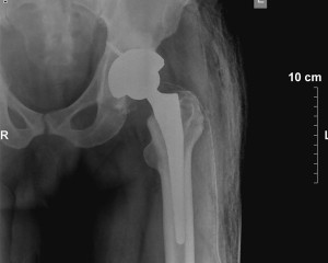 After Hip Replacement Operated by Dr. Ram Soni