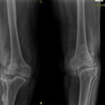 knee replacement surgery