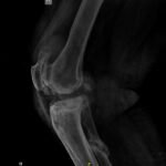 knee replacement surgery