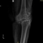 knee replacement surgery