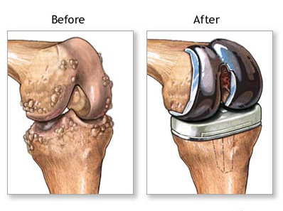 Patient guide to: BEFORE & AFTER knee Replacement