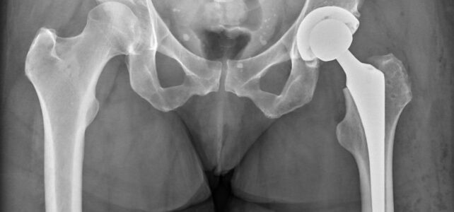 Increased life span after knee and hip replacement